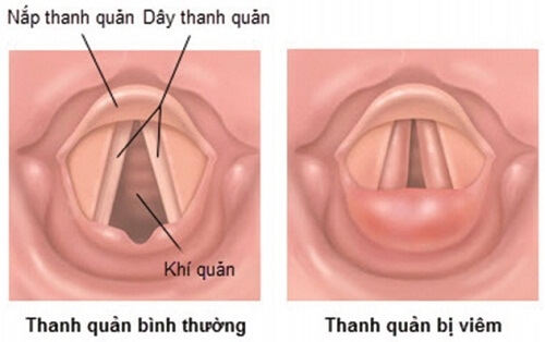 Tưởng mắc xương cá, không ngờ dính phải căn bệnh chết người - Ảnh 4.