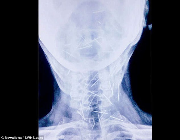 4 tháng ròng vái tứ phương không ra bệnh, bác sĩ kinh ngạc khi nhìn phim x-quang của bệnh nhân - Ảnh 4.