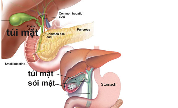 Triệu chứng âm thầm báo hiệu bệnh ung thư túi mật - Ảnh 1.