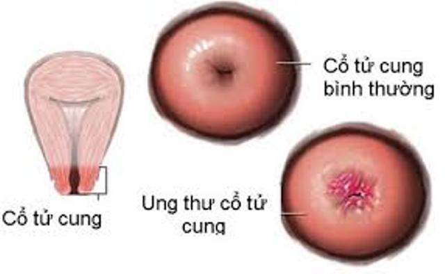 2.500 ca tử vong vì ung thư cổ tử cung mỗi năm tại Việt Nam - Ảnh 2.