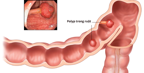 Biến chứng của bệnh polyp đại tràng - Ảnh 2.