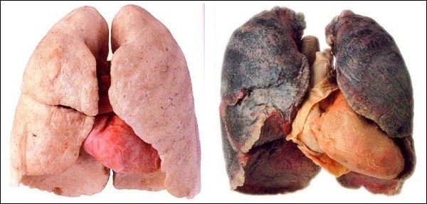 Ung thư phổi – kẻ sát thủ hàng nghìn người Việt mỗi năm - Ảnh 2.