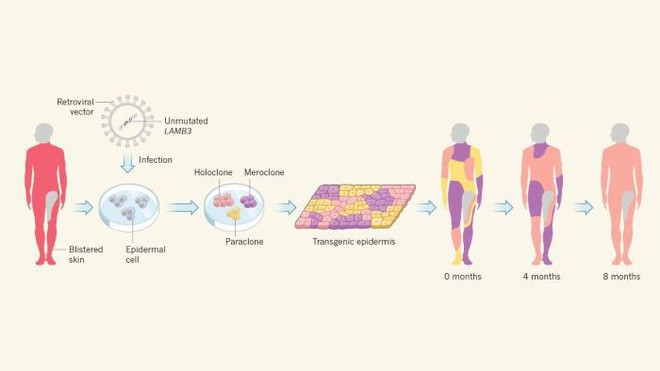 Lần đầu tiên trong lịch sử, các nhà khoa học thay thế 80% bộ da một người bằng da chỉnh sửa gen - Ảnh 3.