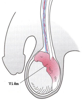 Viêm mào tinh hoàn - bệnh lý liên quan đến vô sinh ở nam giới - Ảnh 2.