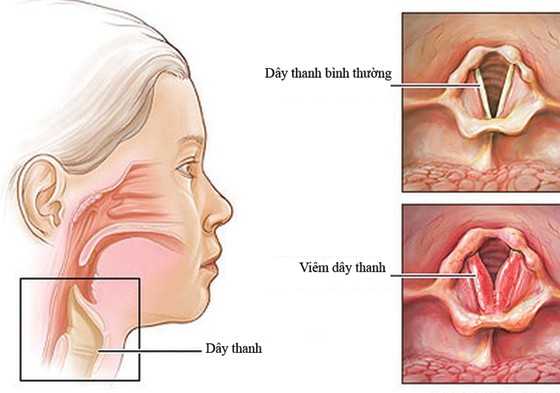 Cách phòng viêm thanh quản - Ảnh 2.