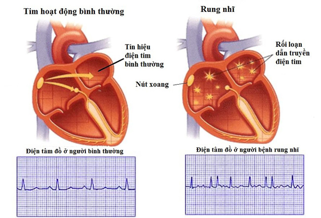 6 dấu hiệu cảnh báo có thể bạn đang bị bệnh tim tiềm ẩn mà không hề hay biết - Ảnh 5.