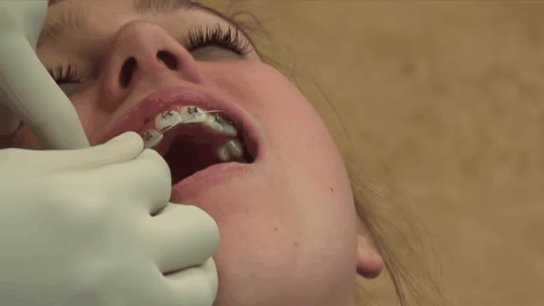 Nếu muốn biết một ca niềng răng diễn ra như thế nào, hãy xem bài viết này! - Ảnh 5.