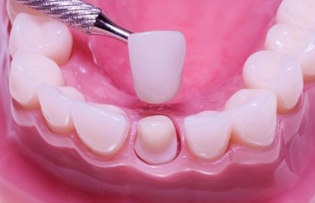 Bọc răng sứ thay đổi tướng mạo: Coi chừng viêm lợi, vỡ răng - Ảnh 2.
