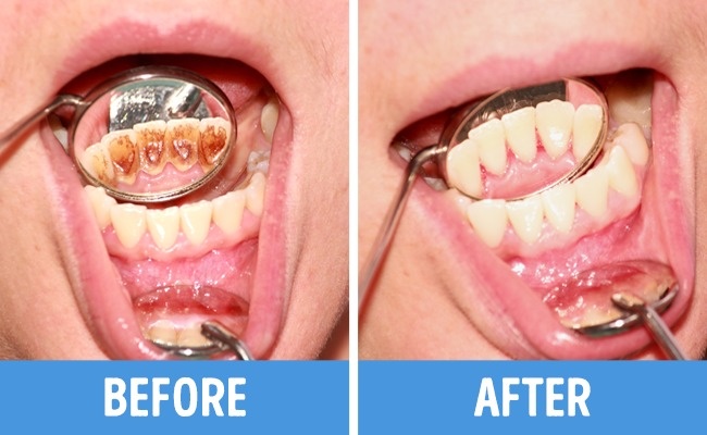 Nếu bạn phạm phải 6 thói quen này trong chăm sóc răng miệng thì cần phải loại bỏ ngay - Ảnh 6.