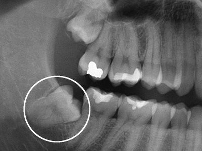 Chuyên gia giải đáp: Vì sao răng khôn thi thoảng trồi lên như 1 vị thần? - Ảnh 6.