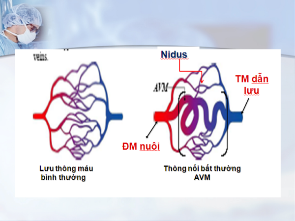 Dị dạng động tĩnh mạch - căn bệnh khiến nữ diễn viên như quả bom hẹn giờ - Ảnh 6.