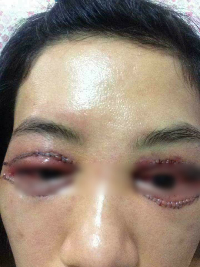 Là tiểu phẫu nhưng cắt mí hay bóc mỡ bọng mắt cũng có thể gây ra những hậu quả nhìn kinh khủng như thế này - Ảnh 6.