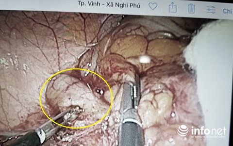 Chuyện kỳ lạ ở Nghệ An: Một bệnh nhân phải cắt ruột thừa... 2 lần - Ảnh 8.