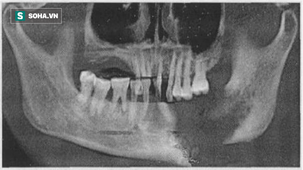 Cảnh báo: Bị đau răng chần chừ không đi khám, đến khi không chịu được thì đã hoại tử hàm - Ảnh 1.