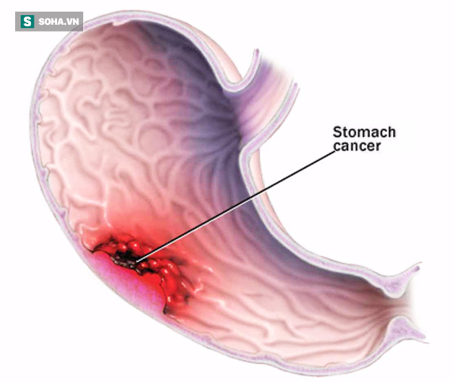 Đừng chờ đến lúc đau, 6 dấu hiệu phải đi khám ung thư dạ dày ngay đừng chậm trễ  - Ảnh 1.