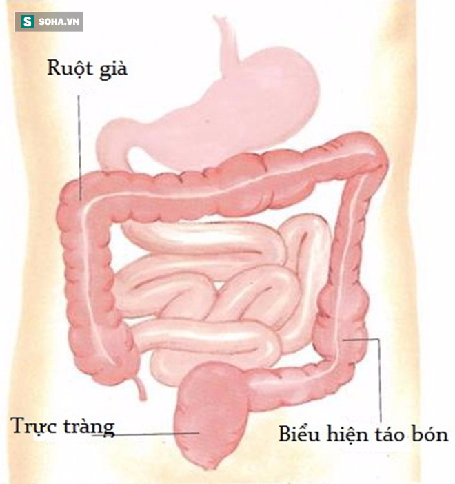 Những nguy hiểm khôn lường khi bị táo bón lâu ngày mà bạn không ngờ tới - Ảnh 1.