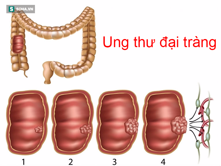 3 dấu hiệu của polyp đại trực tràng: Nguy cơ phát sinh ung thư nếu không điều trị sớm - Ảnh 2.