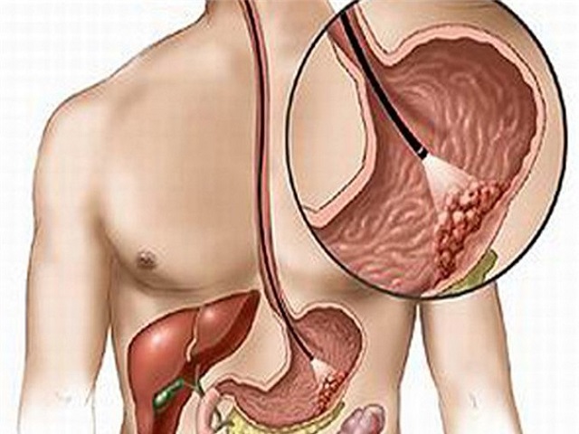 Triệu chứng gặp khi đi đại tiện có thể là cảnh báo ung thư dạ dày, gan, ruột, tuyến tụy - Ảnh 2.
