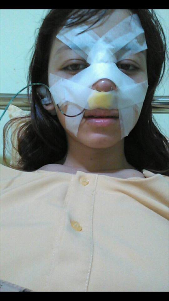 Cô gái chịu đau đớn chết đi sống lại khi nâng mũi để sửa tướng - Ảnh 2.