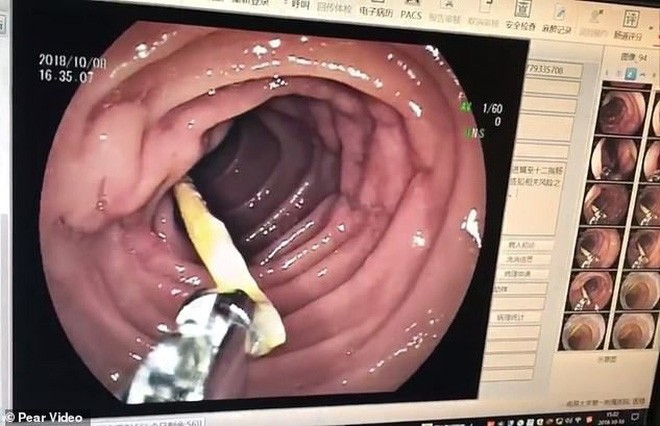 Đau bụng cả tháng, người phụ nữ đi khám phát hiện thấy một cây tăm nhọn dài 7cm không hiểu từ đâu chui vào bụng - Ảnh 1.