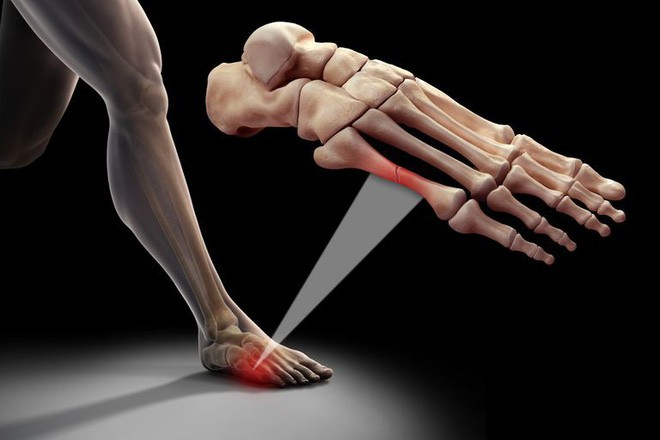 Gãy ngón chân sẽ tự khỏi mà không cần bó bột: Hóa ra đây là 5 điều mọi người hay hiểu lầm về xương - Ảnh 4.