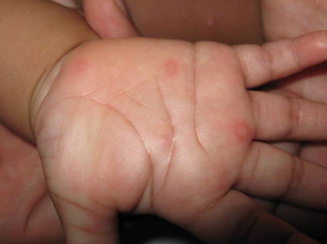 Trẻ bị tay chân miệng có 3 dấu hiệu sau có thể diễn biến nặng: Cần chú ý để xử trí kịp thời - Ảnh 1.