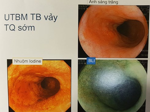 PGS Nhật Bản chỉ rõ đối tượng có nguy cơ cao mắc ung thư thực quản - Ảnh 3.