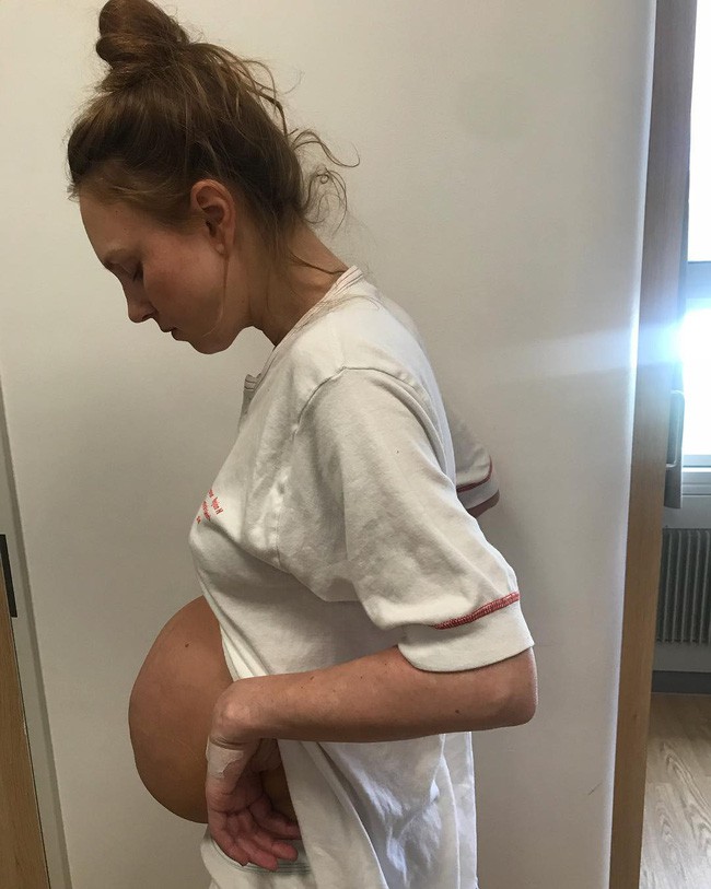Bà mẹ sinh ba có bụng bầu dài bất thường lại gây sốt với vòng hai như chưa đẻ sau khi sinh 1 tháng - Ảnh 2.