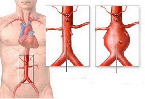 Những bệnh cần đề phòng khi bị đau lưng - Ảnh 1.