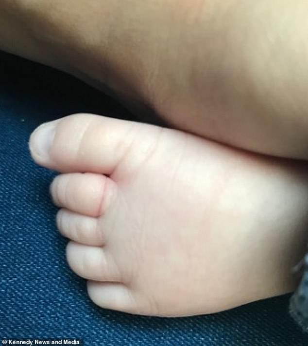 Sợi tóc của mẹ thít chặt vào chân, bé 10 tuần tuổi suýt phải cắt cụt 4 ngón - Ảnh 4.