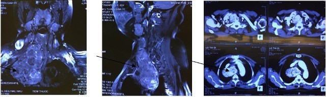 Bướu giáp khổng lồ chui sâu vào lồng ngực cụ bà suốt 10 năm, gây khó thở nặng - Ảnh 1.