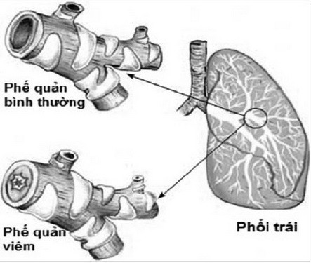 Hen phế quản dễ tái phát khi trời lạnh - Ảnh 1.