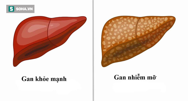 Bệnh gan nhiễm mỡ luôn để mắt tới bạn: 5 giải pháp ai cũng nên làm để tránh bị tấn công - Ảnh 1.