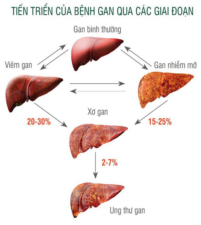 Bệnh gan nhiễm mỡ luôn để mắt tới bạn: 5 giải pháp ai cũng nên làm để tránh bị tấn công - Ảnh 2.