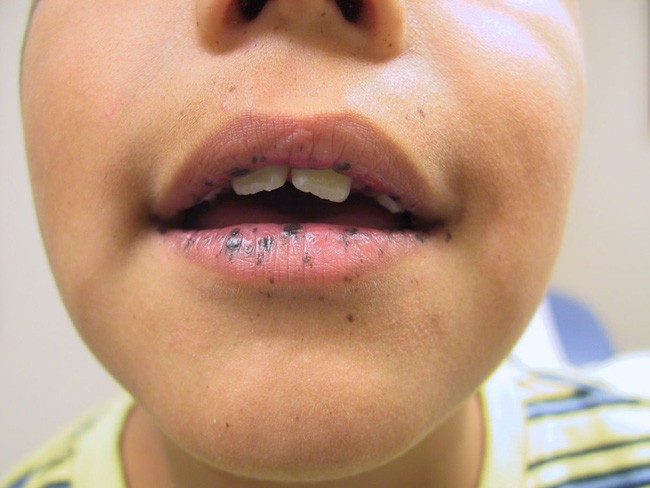 Thấy trẻ đau bụng, có vết đen lạ trên môi: Cha mẹ coi chừng con mắc hội chứng nguy hiểm, dễ dẫn đến ung thư - Ảnh 4.