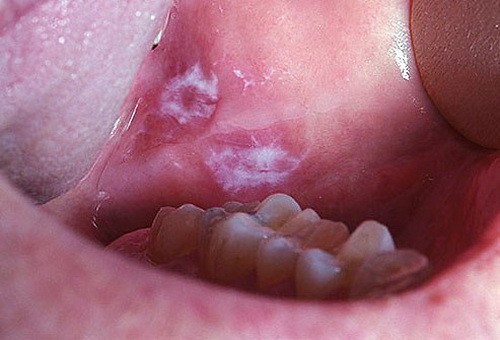 Bệnh răng miệng do thuốc lá gây ra - Ảnh 2.