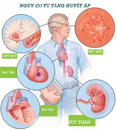 Bất ngờ mất mạng vì suy tim do huyết áp cao không điều trị - Ảnh 1.