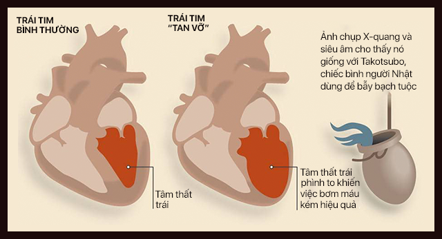 Trái tim: Nơi chứa đựng cảm xúc hay chỉ là một cái máy bơm không hơn không kém? - Ảnh 11.