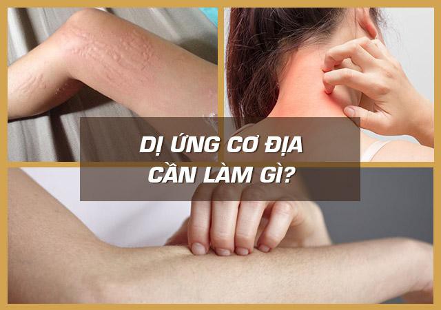 Dị ứng cơ địa, nổi mề đay mẩn ngứa và cách chữa hiệu quả nhờ bài thuốc nam sau - Ảnh 1. Dị ứng cơ địa, nổi mề đay mẩn ngứa và cách chữa hiệu quả nhờ bài thuốc nam sau - Ảnh 1.