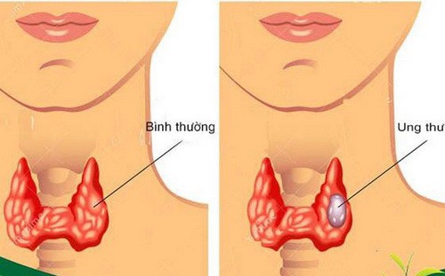 Cách phát hiện sớm ung thư tuyến giáp - Ảnh 1.