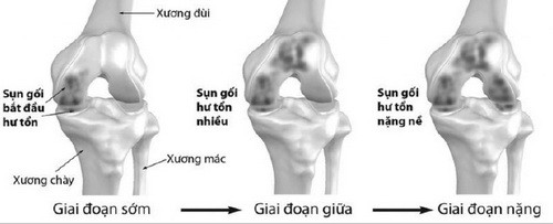 Thoái hóa khớp gối: Chữa càng muộn càng khổ - Ảnh 1.