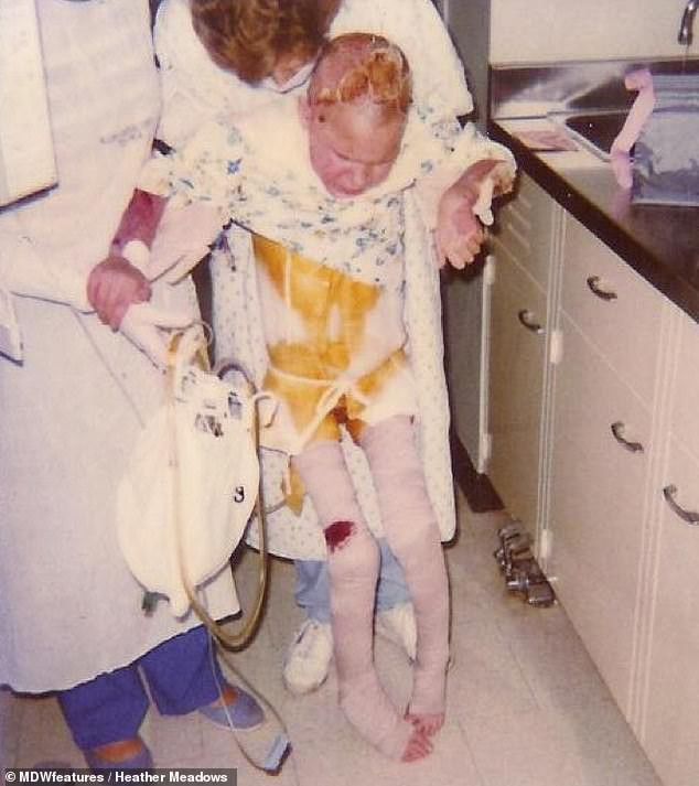 Đứa trẻ 7 tuổi toàn thân bốc cháy như đuốc sau tai nạn kinh hoàng, 30 năm trôi qua ai cũng tròn mắt khi nhìn thấy cơ thể cô ấy - Ảnh 2.