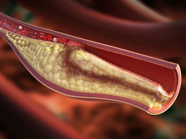 Liệu pháp đơn giản giúp giảm cholesterol - Ảnh 1.