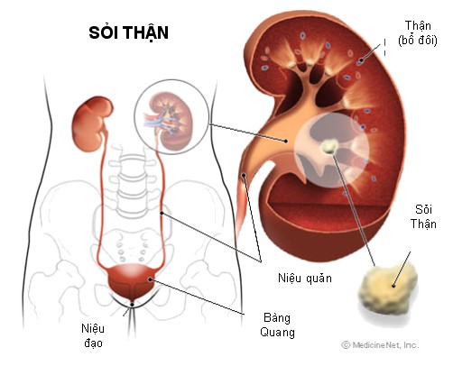 Bài thuốc trị sỏi niệu do thấp nhiệt - Ảnh 1.