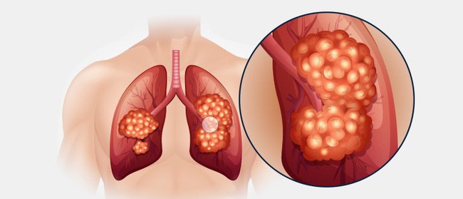 Từ một cái hắt hơi mạnh co thắt cơ lưng, cô gái 19 tuổi tràn trề nhựa sống bỗng phải nhận án ung thư phổi - Ảnh 3.