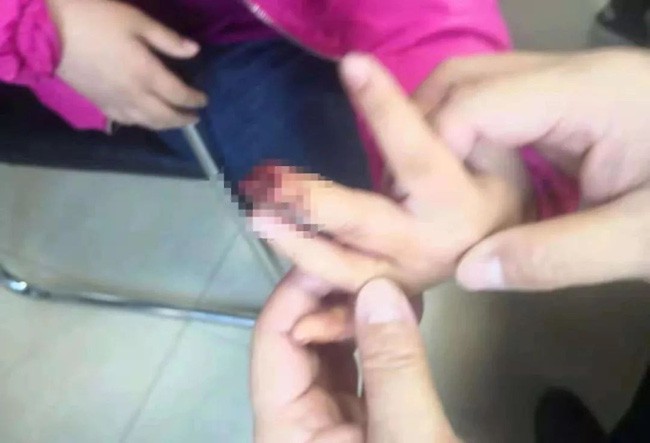 Bé gái 9 tuổi phải cưa ngón tay vì cách sơ cứu sai lầm của bà nội sau khi bị kẹt tay vào cửa - Ảnh 1.