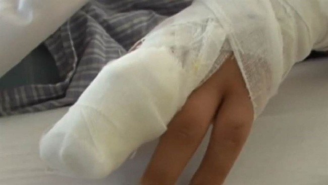 Bé gái 9 tuổi phải cưa ngón tay vì cách sơ cứu sai lầm của bà nội sau khi bị kẹt tay vào cửa - Ảnh 3.
