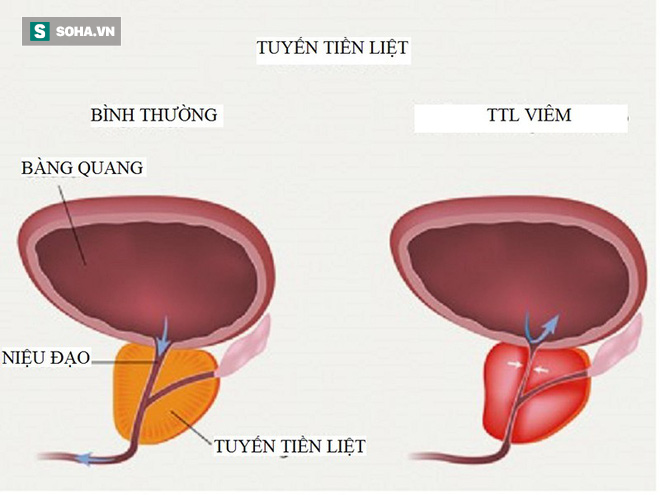 Bác sĩ cảnh báo sớm 5 triệu chứng viêm tuyến tiền liệt: Nếu ai thấy giống là phải đi khám - Ảnh 1.