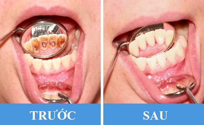8 sai lầm phổ biến gây hại răng miệng: Chắc chắn ai cũng dính ít nhất một cái - Ảnh 5.