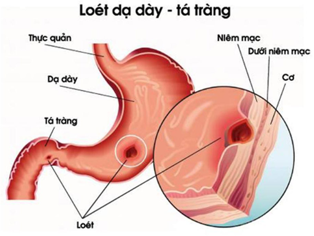 Thảo dược trị viêm dạ dày tá tràng - Ảnh 1.